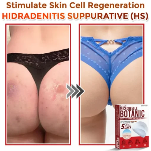 Cvreoz® MicroNeedle Botanic Skin Tag Removal Patch