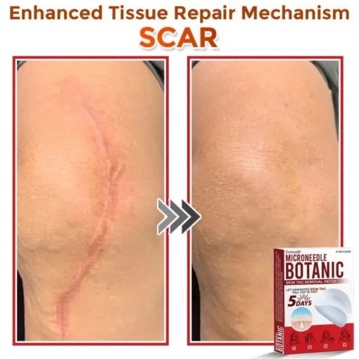 Cvreoz® MicroNeedle Botanic Skin Tag Removal Patch