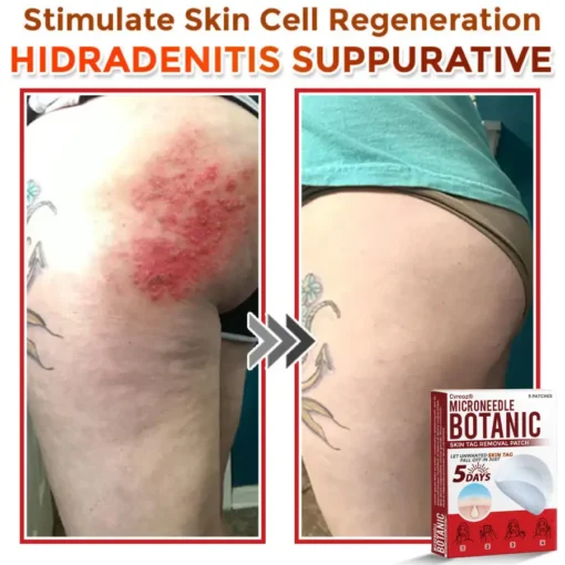 Cvreoz® MicroNeedle Botanic Skin Tag Removal Patch
