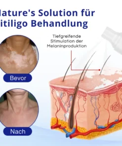 Cvreoz® Spray gegen Vitiligo