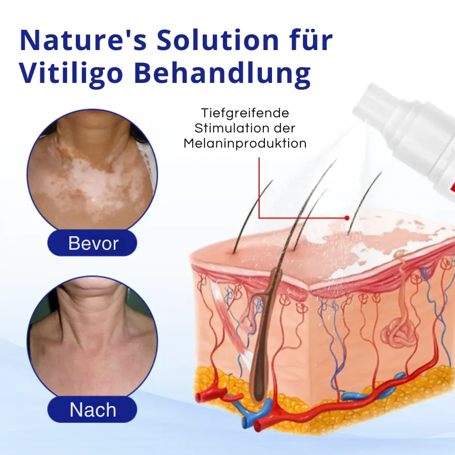 Cvreoz® Spray gegen Vitiligo