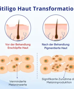 Cvreoz® Spray gegen Vitiligo