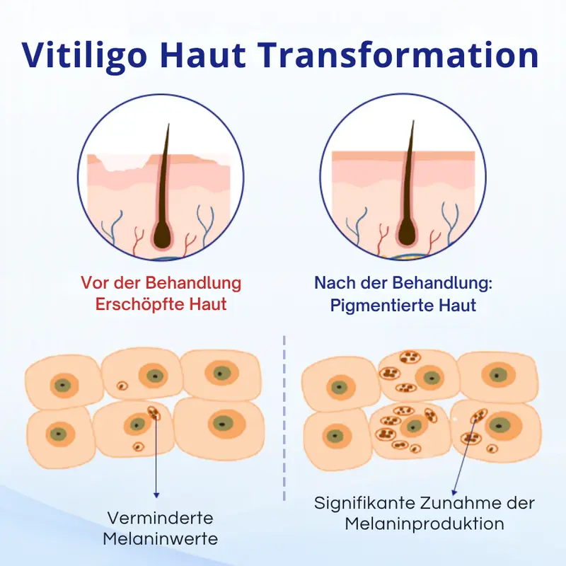 Cvreoz® Spray gegen Vitiligo