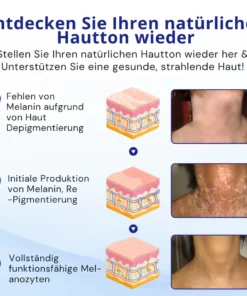 Cvreoz® Spray gegen Vitiligo