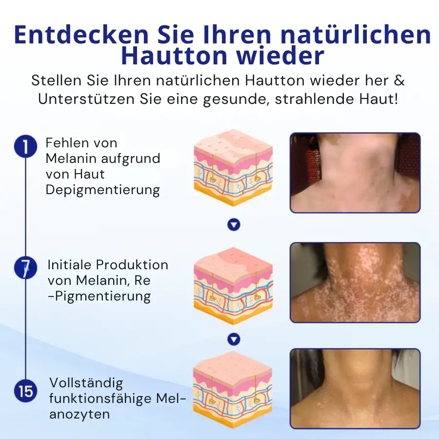 Cvreoz® Spray gegen Vitiligo