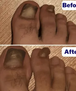 Cvreoz® Nail Fungal Patches Pro+