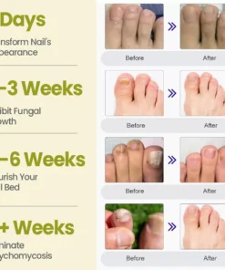 Cvreoz® Nail Fungal Patches Pro+