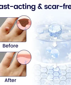 Cvreoz® WartFreez Cryo Wart Removal Spray