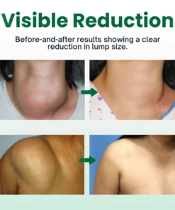 Cvreoz® Knot-X Lipoma Dissolve Cream