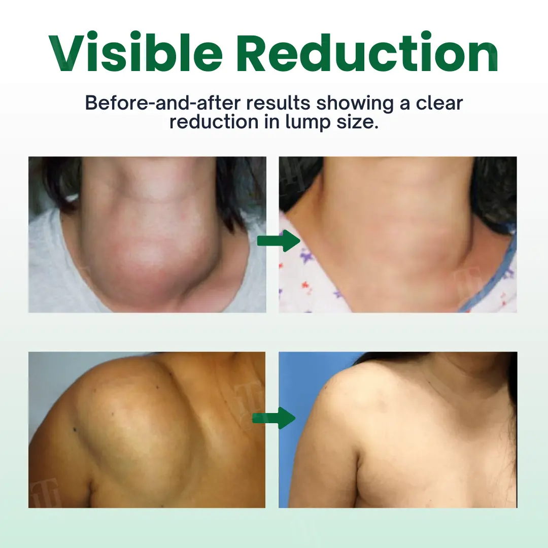 Cvreoz® Knot-X Lipoma Dissolve Cream