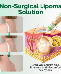 Cvreoz® Knot-X Lipoma Dissolve Cream