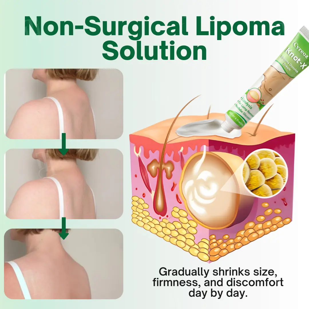 Cvreoz® Knot-X Lipoma Dissolve Cream