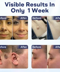 Cvreoz® Mole and Wart Removal Cream