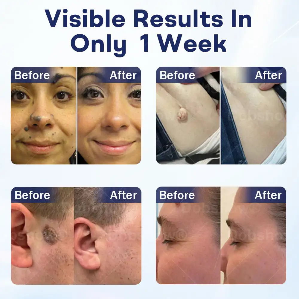 Cvreoz® Mole and Wart Removal Cream