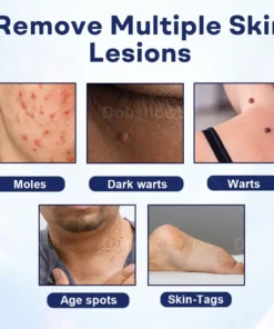 Cvreoz® Mole and Wart Removal Cream