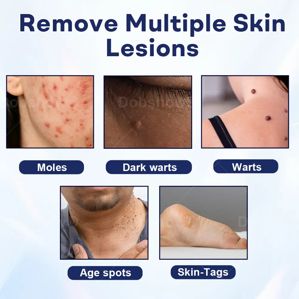 Cvreoz® Mole and Wart Removal Cream