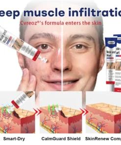 Cvreoz® Mole and Wart Removal Cream