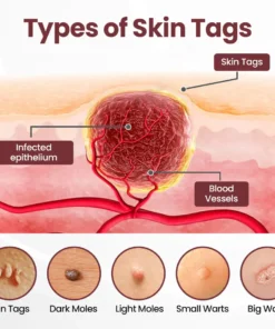 Cvreoz® OryzaClear Black Rice Botanical Keratin-Softening Cream