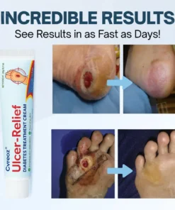 Cvreoz® Ulcer-Relief Diabetes Treatment Cream