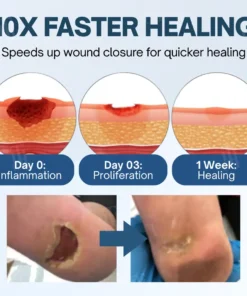 Cvreoz® Ulcer-Relief Diabetes Treatment Cream