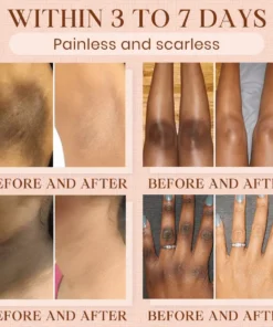 Cvreoz® Purifying Exfoliating Gel for Acanthosis Nigricans, Exfoliation, Dark Spots, Skin Tags, and Eczema